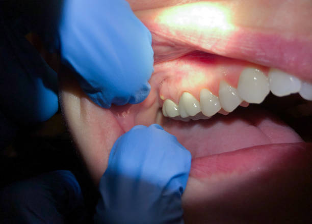 Best Urgent Care for Lost Fillings or Crowns in Rockdale, IL